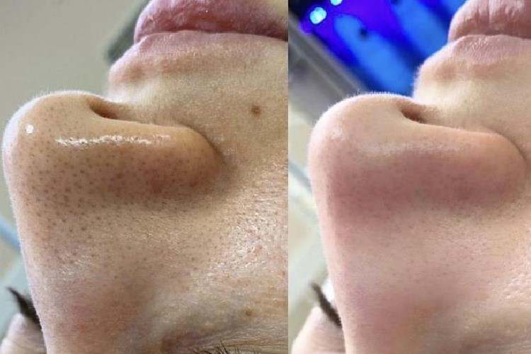 Deep Cleansing Facial: Everything You Need to Know About It!