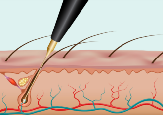 Electrolysis Hair Removal Tips and Tricks: Pre and Post-Care for Best Results