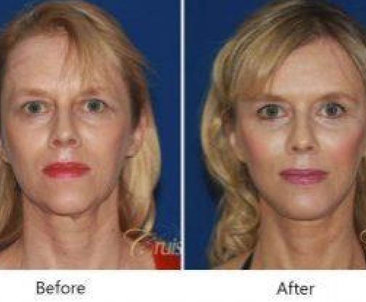 How to Get Rid of Marionette Lines? Treatment Options and Home Remedies