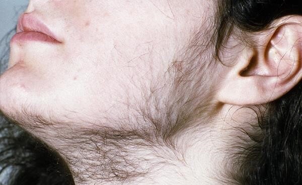Hypertrichosis vs. Hirsutism: Causes, Difference, and Treatments