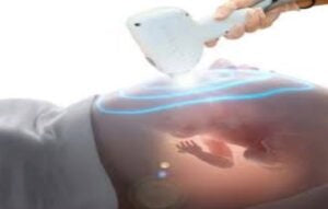 Can You Do Laser Hair Removal While Pregnant?