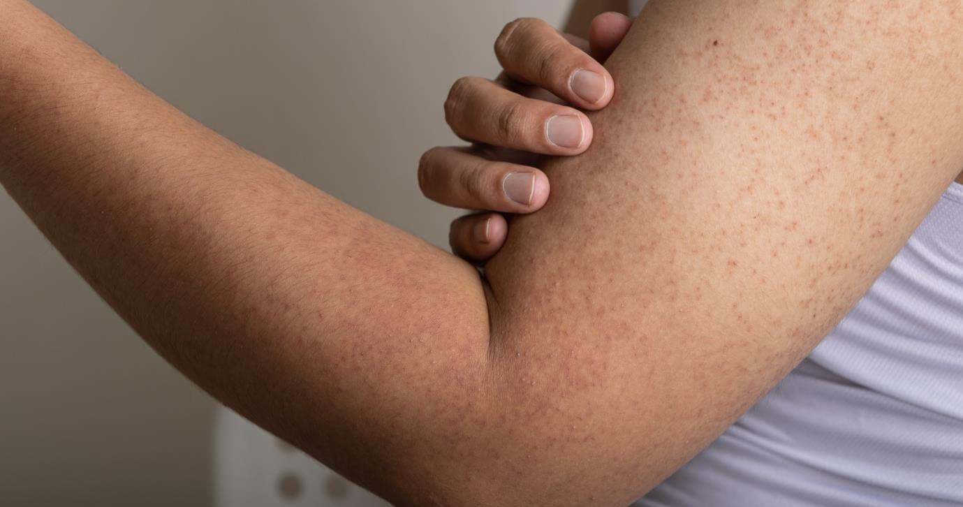 How to Get Rid of Strawberry Arms Fast at Home? (9 Ways)