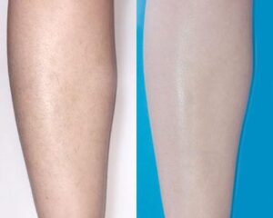 A Guide to IPL Hair Removal Results for Smooth Skin