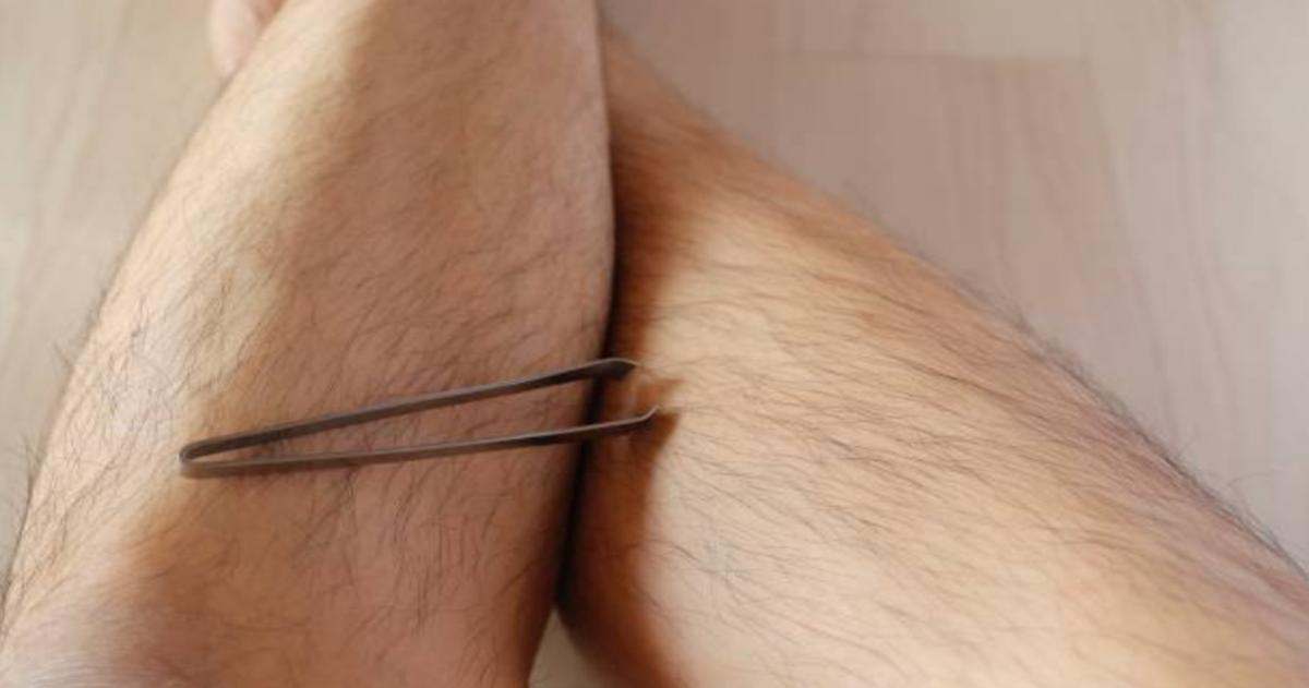 I Plucked My Hair After Laser, Any Side Effects?