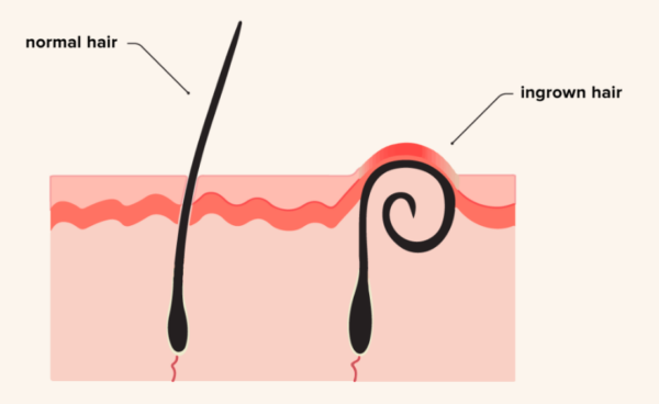 Will Laser Hair Removal Get Rid of Ingrown Hairs? Does It Cause Ingrown Hairs?