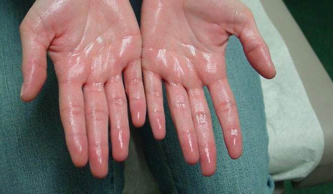 Why Do My Armpits Sweat So Much?