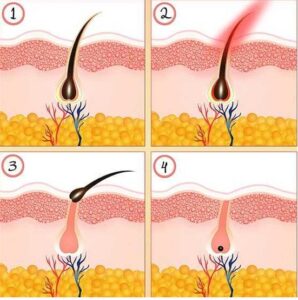 IPL vs. Salon Laser Hair Removal: Which is Better?