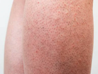 Will Laser Hair Removal Get Rid of Strawberry Legs?