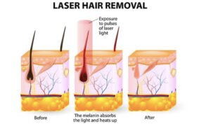 Does Hair Grow Back After Laser Hair Removal? (& Faqs)