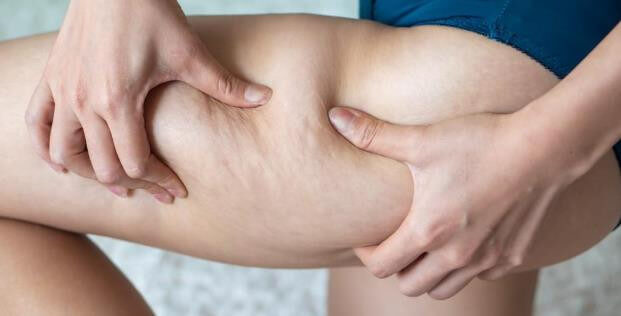 How to Get Rid of Cellulite on Buttocks Naturally?