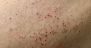 Why Do I Have Red Bumps After Using Hair Removal Creams?