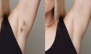 Can the IPL Device be Used for Whole-Body Hair Removal?