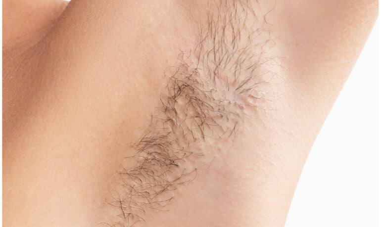 Hyperpigmentation Around Mouth: Causes, Treatment, and Home Remedies