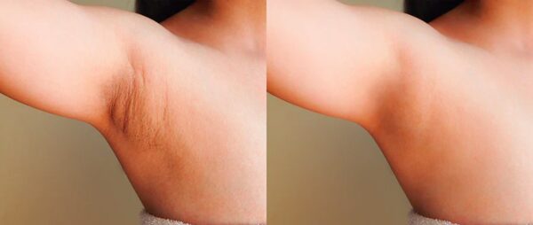 How to Remove Dark Spots Under Armpits Fast?