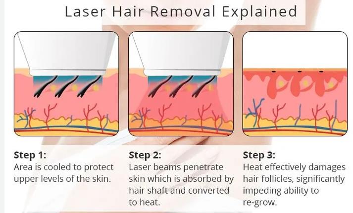 Face Laser Hair Removal: Procedure, Benefits, and More
