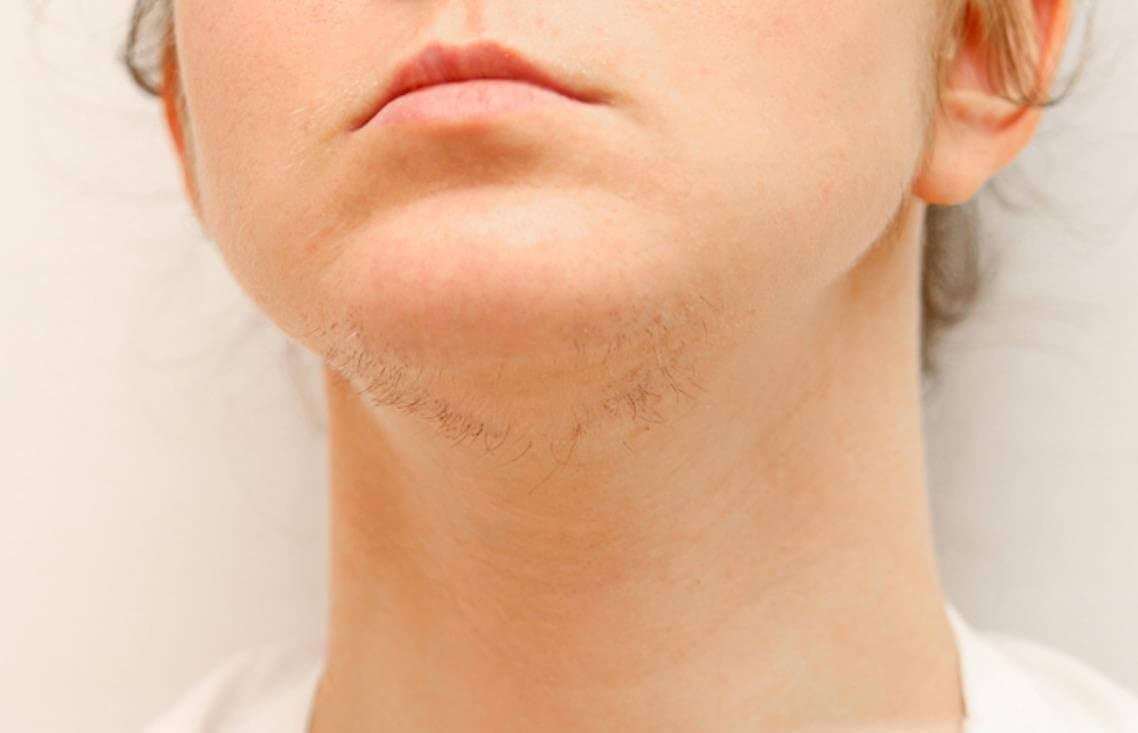 How to Correctly use IPL Hair Removal for Women with PCOS? (Tutorial)