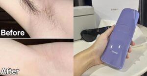 Get Beach Vacation Ready with Bikini Laser Hair Removal at Home (2025)