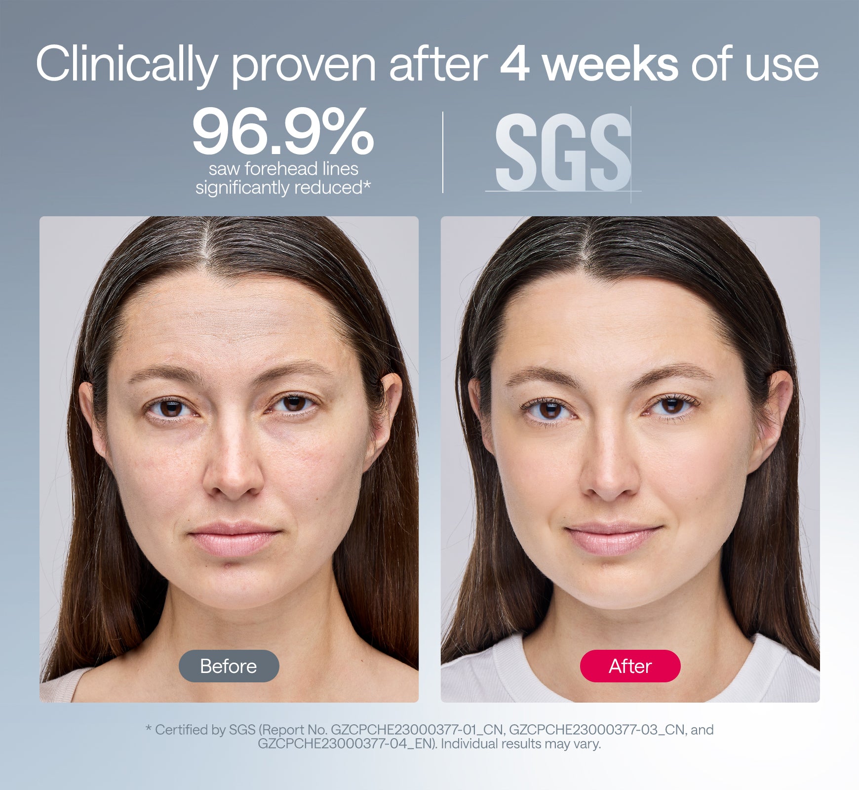 Before and after wrinkle reduction after 4 weeks using Ulike ReGlow LED light therapy mask