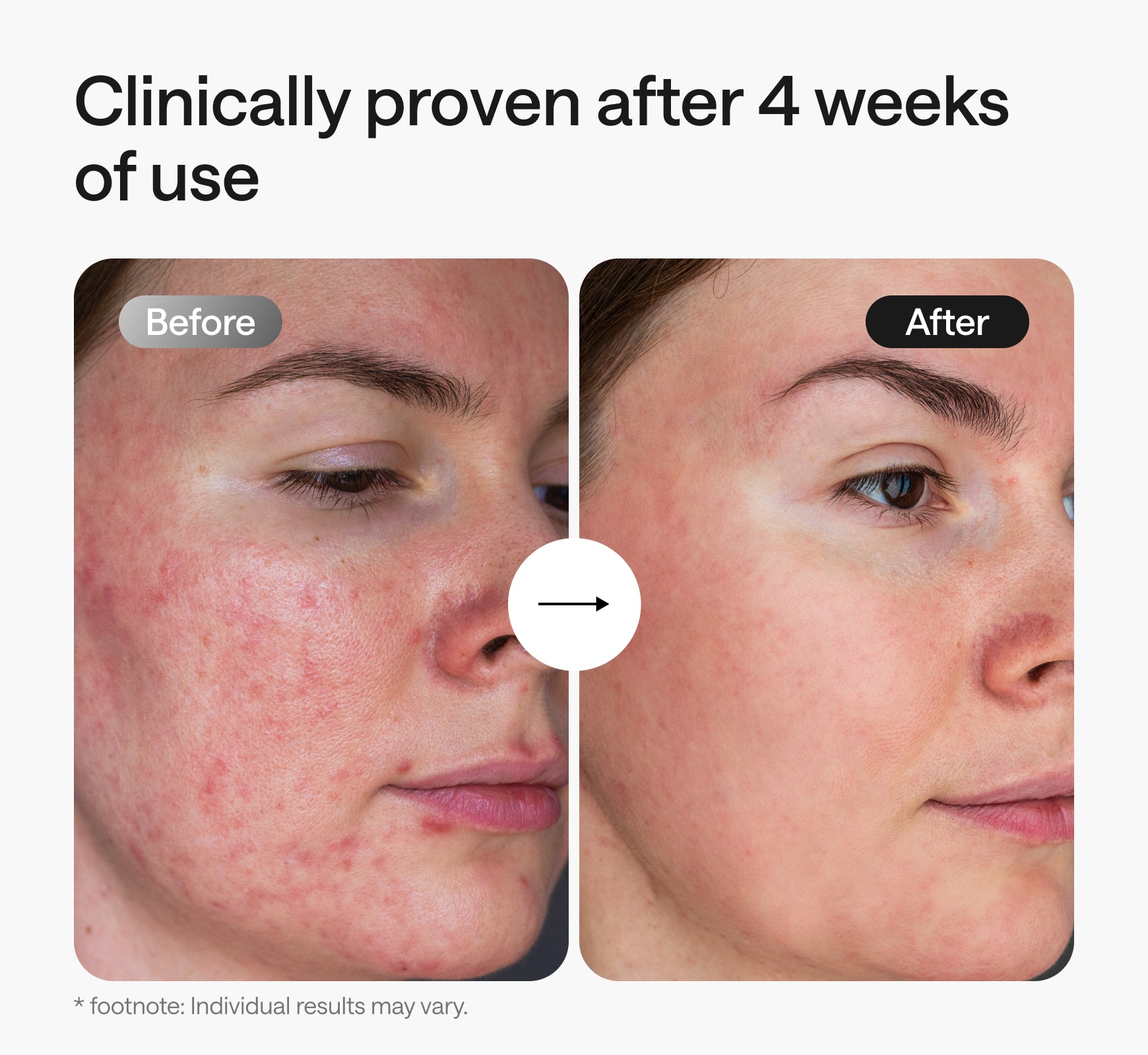 Before and after skin redness improvement after 4 weeks using Ulike LED light therapy mask