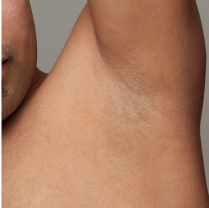 Before and after underarm hair removal comparison on a man, showing a significant reduction in hair for smoother skin.