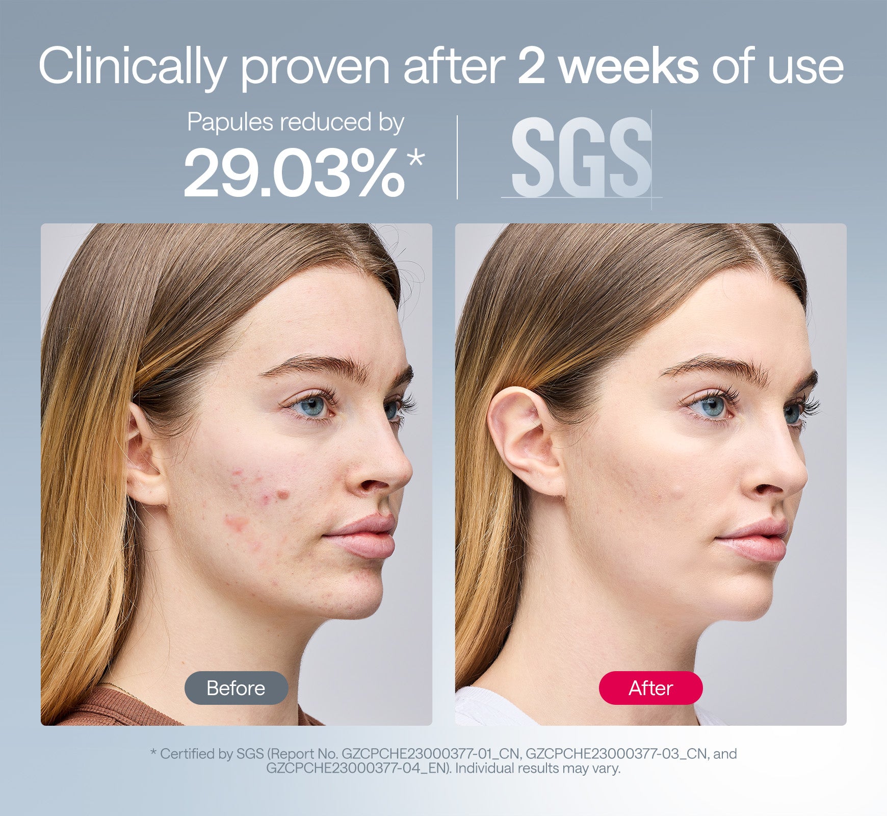 Before and after acne results after 2 weeks using Ulike ReGlow LED light therapy mask