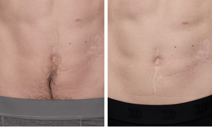 IPL hair removal results on Men’s Stomach before and after