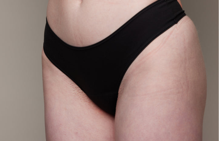 The effect of using ulike air 10 after bikini hair removal