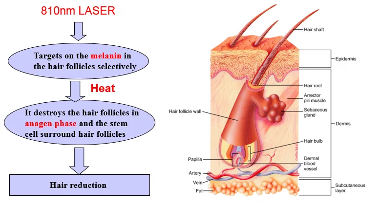 IPL vs. Laser: A Comparison of Light-Based Hair Removal Methods