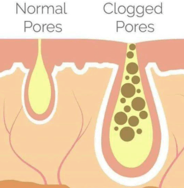 How Your Diet and Gym Habits Are Causing Acne?