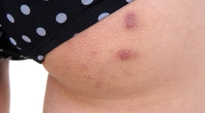 Why Do I Have Ingrown Hair on Nipple? 