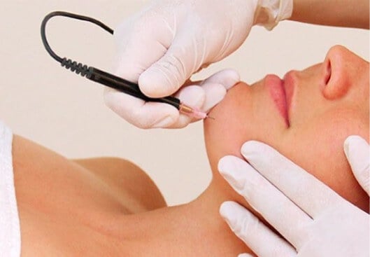Electrolysis vs. Laser Hair Removal: Which Should You Choose?