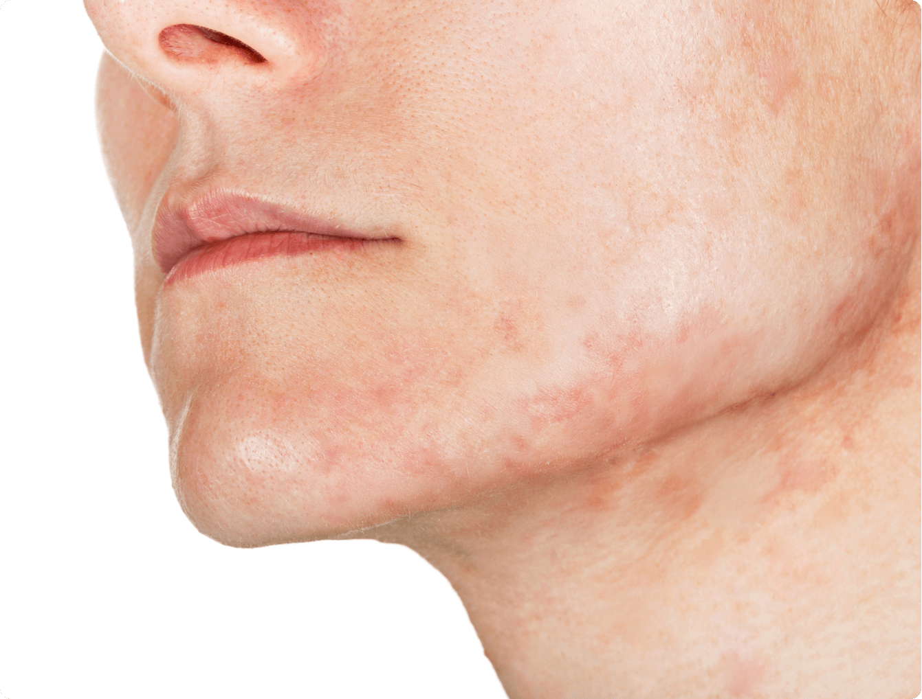 Adult Acne and LED Masks: Causes, Triggers, and How Light Therapy Fits In