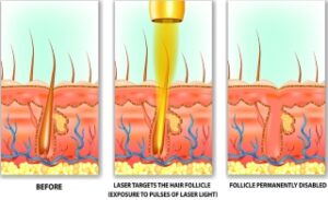 How Laser Hair Removal Can Shape Your Beard Line?