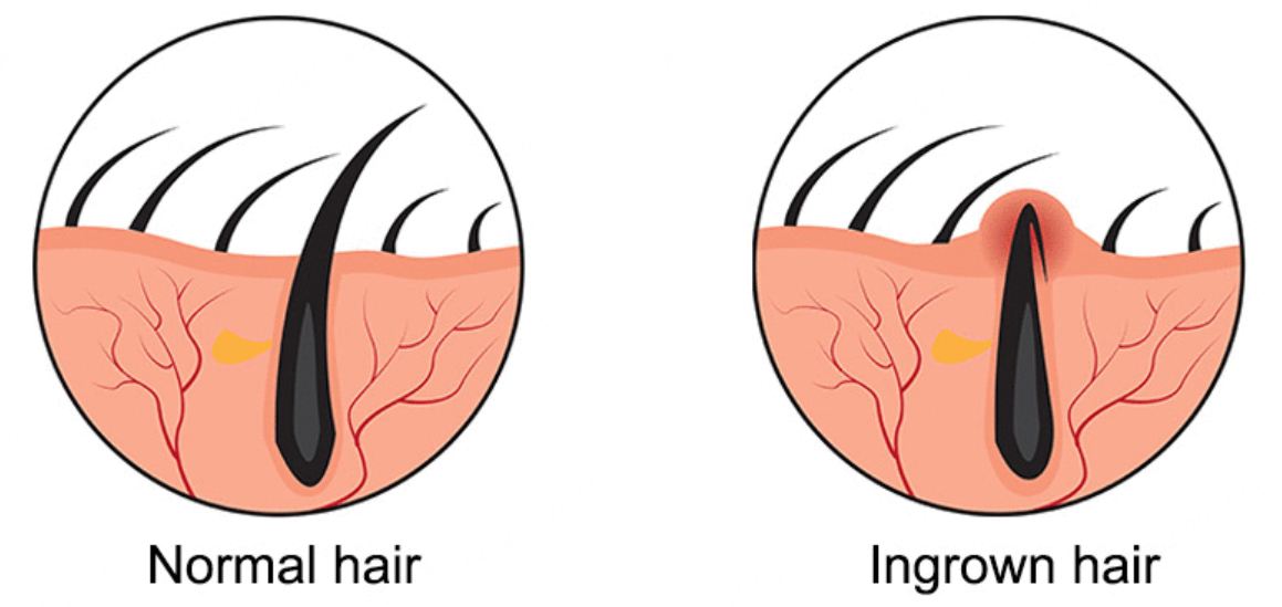 Ingrown Hair: What It Looks Like, Causes, Treatment &amp; Prevention
