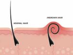 7 Sugaring Hair Removal Disadvantages You Need to Know