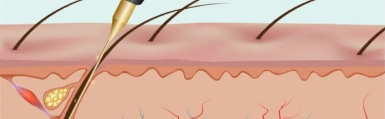 Can Electrolysis Hair Removal be Done at Home?