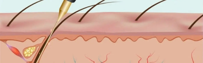 Electrolysis vs. Wax vs. Sugaring: Which Hair Removal Better?