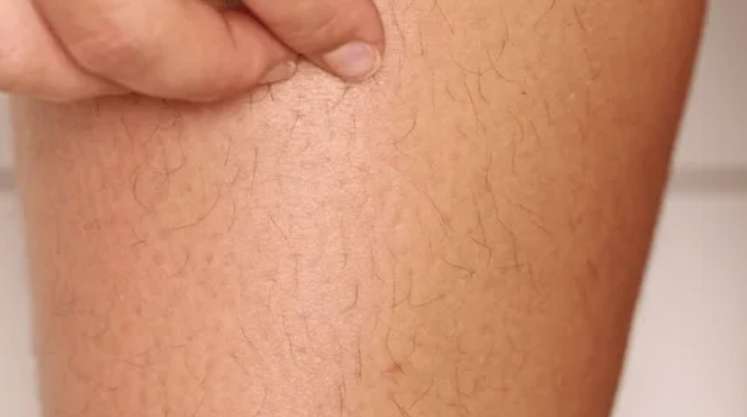 Can Pregnancy Reverse Laser Hair Removal? Latest Findings