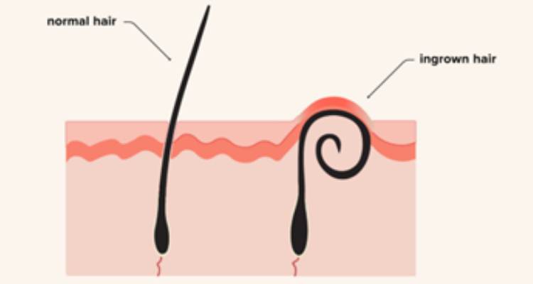 Do You Use Sugar Scrub Before or After Shaving?