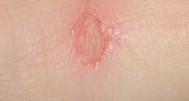 Butt Crack Waxing: Risks and 5 Alternative Hair Removal Ways