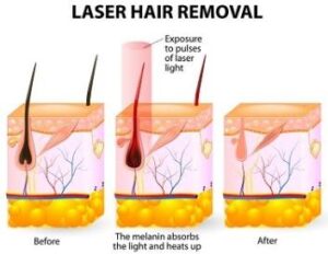 Can IPL Work on Blonde Hair? What to Expect