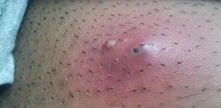 Ingrown Hair vs. Herpes: Signs, Symptoms, and Treatment