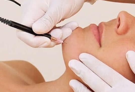 Electrolysis Hair Removal: Benefits, Cost &amp; How Many Treatments