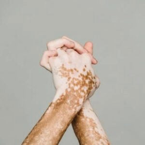 Is Laser Hair Removal Permanent, Is It Safe, and More?