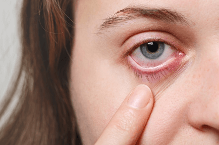 Eyelid Seborrheic Dermatitis: Treatment, Symptoms, and Causes