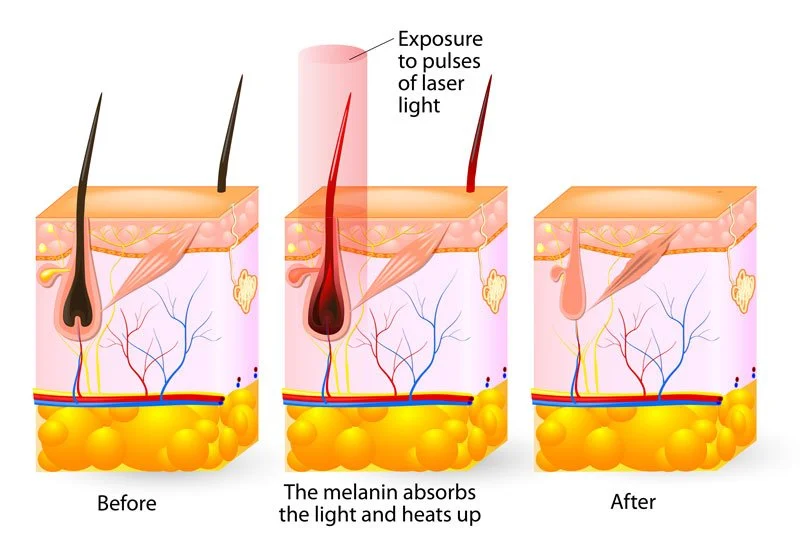 Laser Hair Removal Aftercare: A Dermatologist’s Guide to Optimal Results