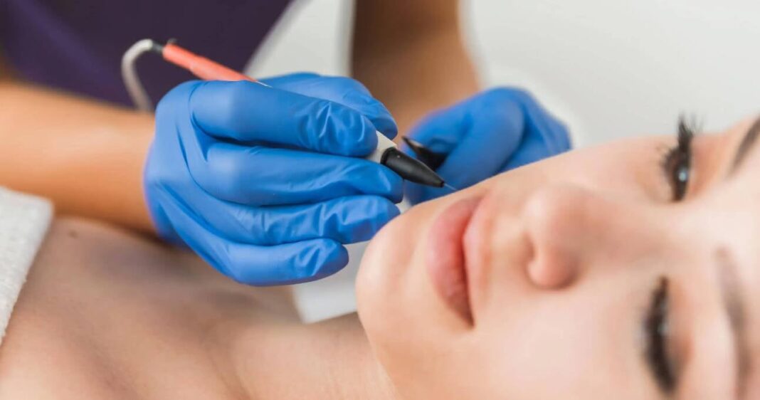Electrolysis Chin Hair Electrolysis Chin Hair