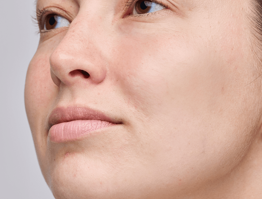 Acne and breakouts