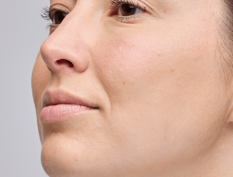 Acne and breakouts