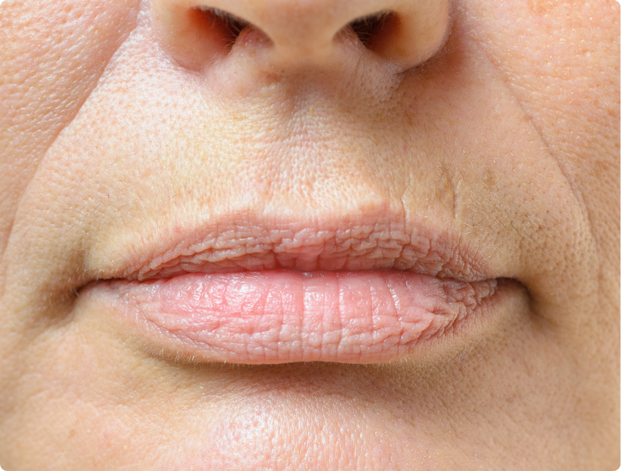 Nasolabial Folds